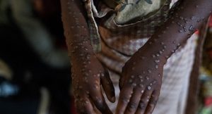 Sierra Leone Reports More Than 2,000 Mpox Cases, 11 Deaths